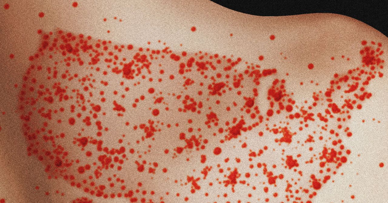 Scientists Find Measles Likely To Become Endemic in the US Over Next 20 Years