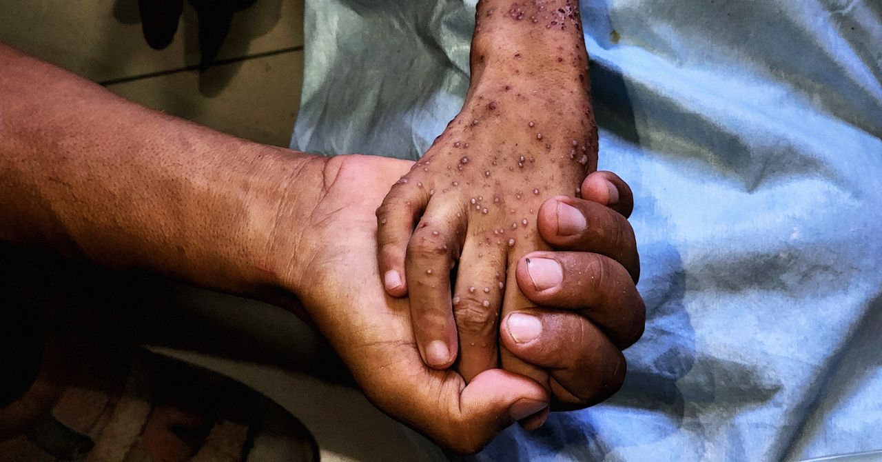 The Grave Long-Term Effects of the Gaza Malnutrition Crisis