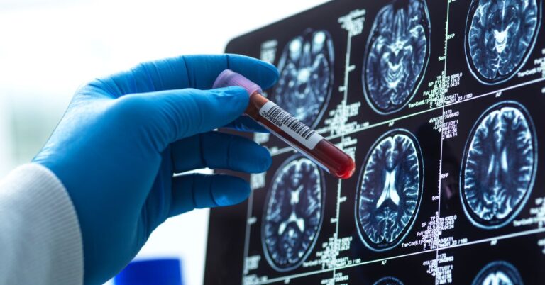 Blood Tests for Alzheimer’s Are Here
      
    
    [wa_source_excerpt]
    
      Source: [wa_source_source] | Published: [wa_source_date]
    
    
      Read full article